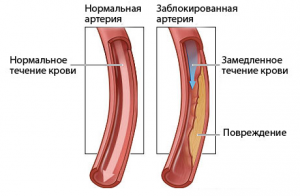 Сравнение здоровой и закупоренной артерий