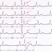 предсердные экстрасистолы на экг
