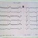 Острый ИМ на ЭКГ