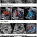 Примеры УЗИ плода