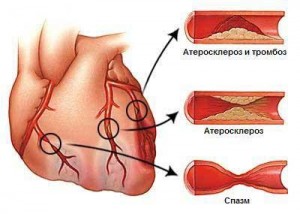 Прогрессирующая стенокардия