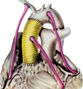 Коронарное шунтированиеКоронарное шунтирование
