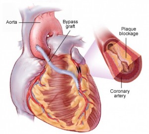 Суть аортокоронарного шунтирования