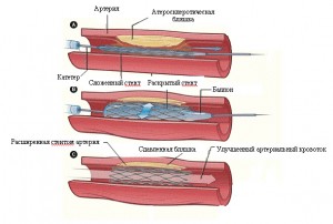 Эндоваскулярное протезирование сосуда