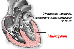 Особенности болезни