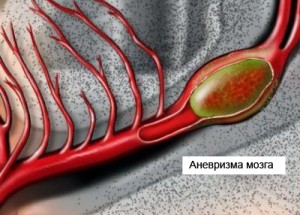 Что такое аневризма головного мозга 