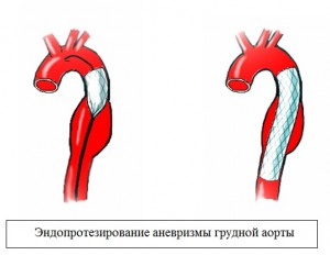 Хирургический метод воздействия