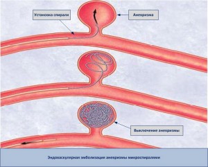 Оперативное лечение аневризмы