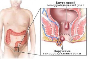 Причины тромбозов и факторы риска