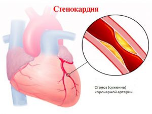 Стенокардия симптомы-1