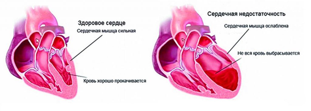 сердечная недостаточность симптомы 10