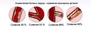 Основная причина синоатриальной блокады.