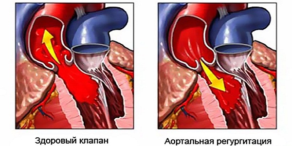 Аортальная недостаточность регургитация и здоровый клапан